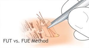 Best Fue Fut Hair Transplant Surgeon Turkey, Fue Fut Hair Restoration Turkey