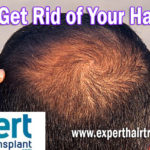 How to Get Rid of Your Hair Loss