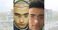 Hairline Lowering Without Surgery Turkey